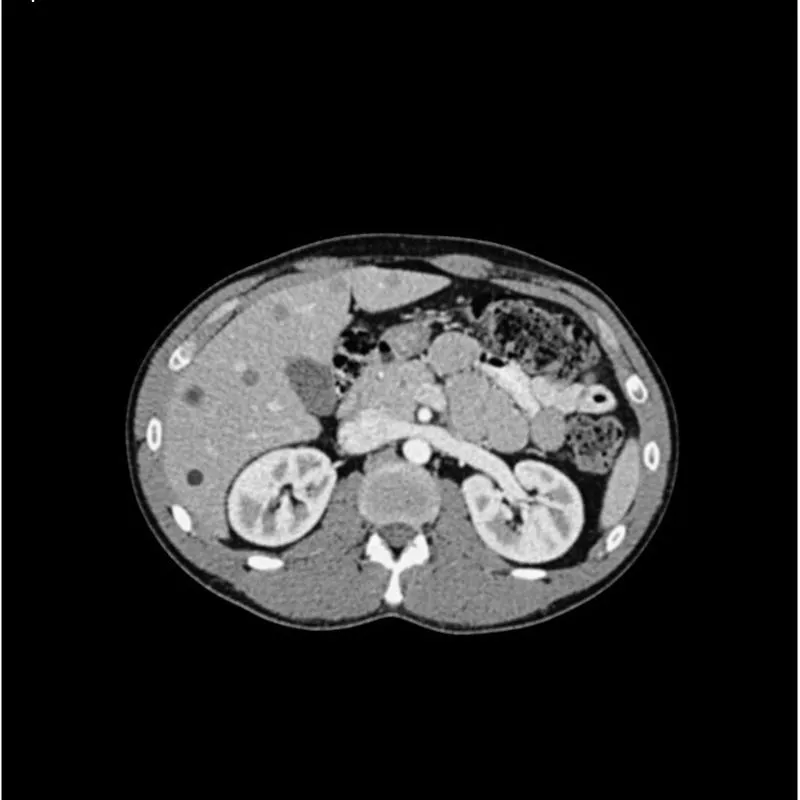 Abdomen Phantom - PV Mixed Cylinders