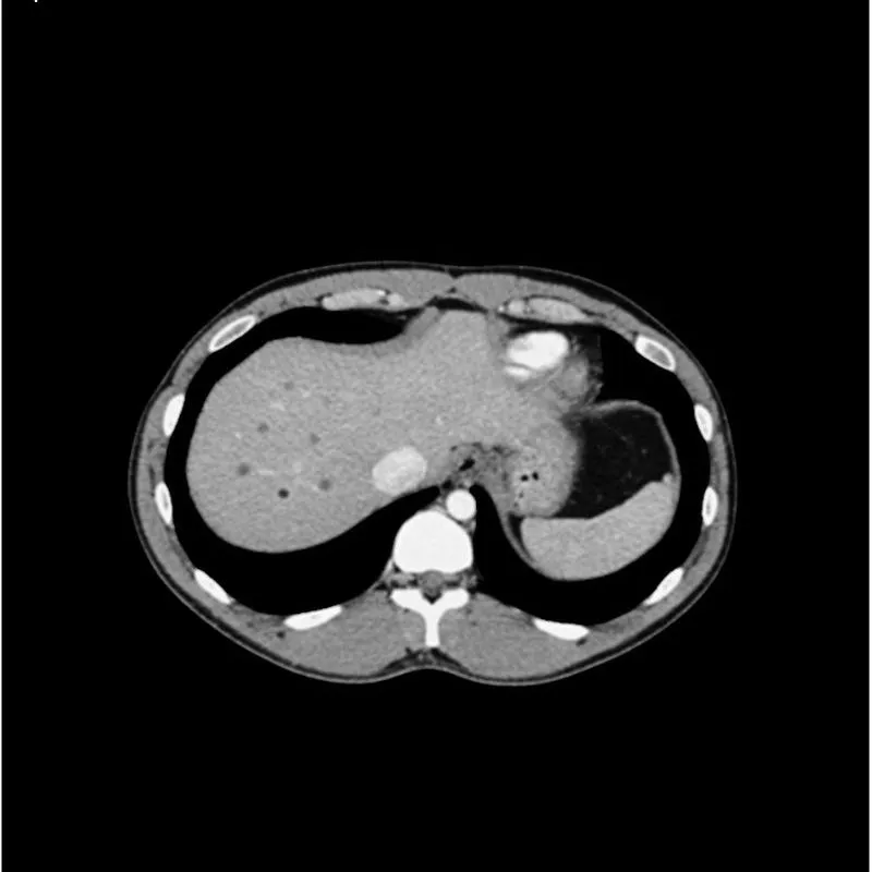 Abdomen Phantom - PV Mixed Cylinders