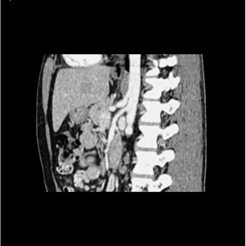 Abdomen Phantom - PV Mixed Cylinders