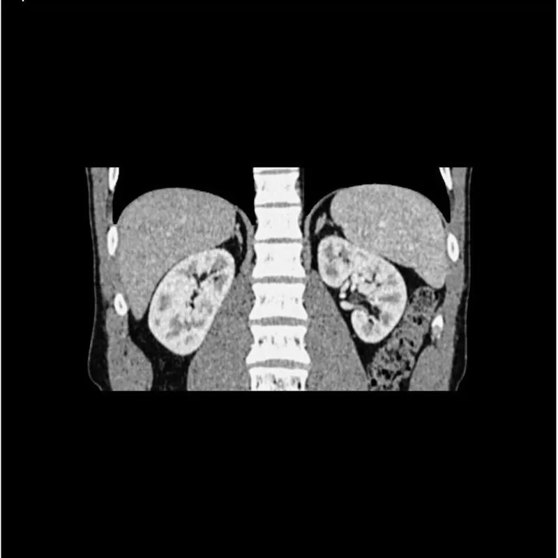 Abdomen Phantom - PV Mixed Cylinders