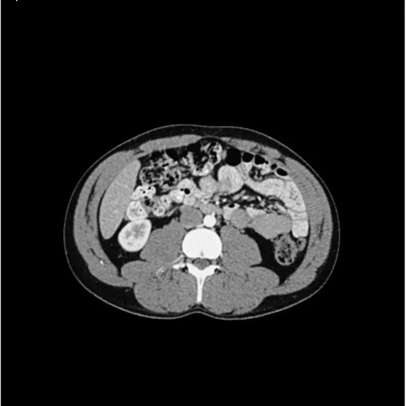 Abdomen Phantom - PV Mixed Cylinders