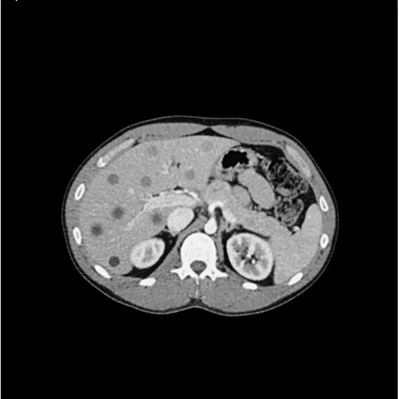 Abdomen Phantom - PV Mixed Cylinders