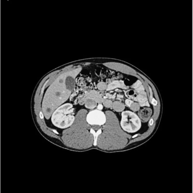 Abdomen Phantom - PV Mixed Cylinders