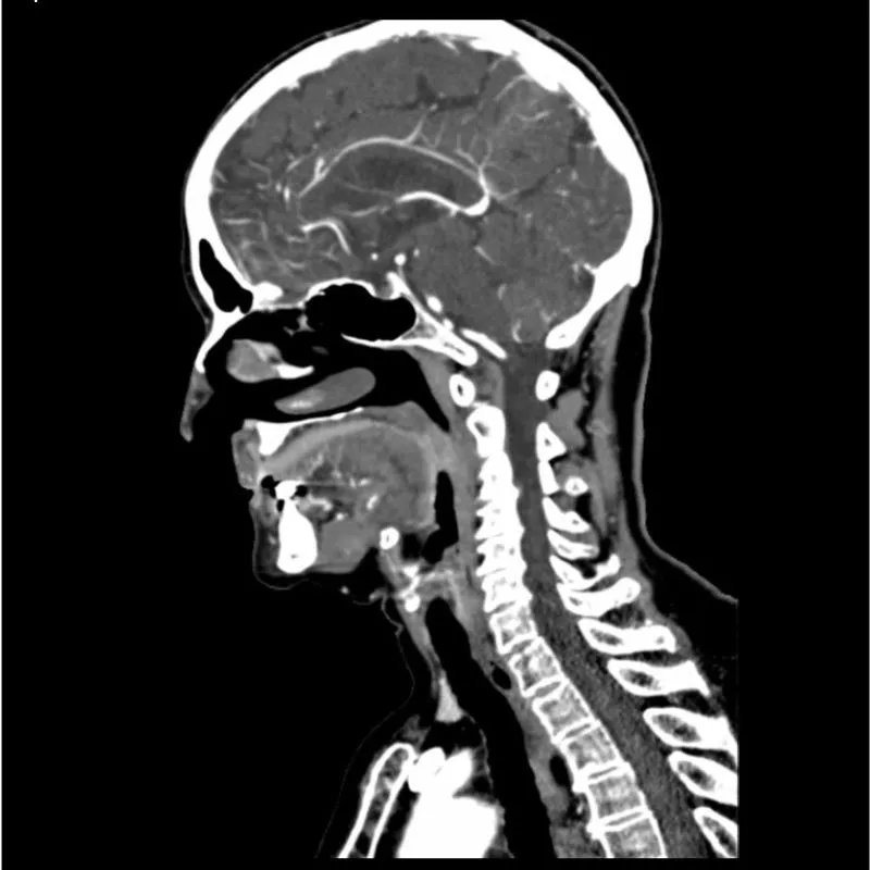 Head and Neck Phantom - CTA