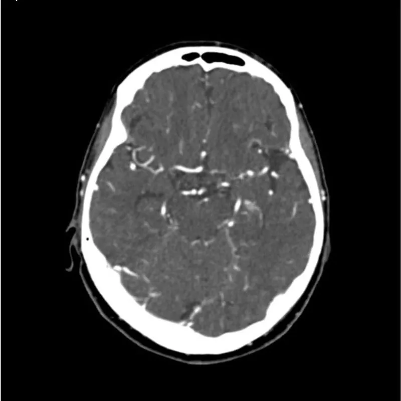 Head and Neck Phantom - CTA