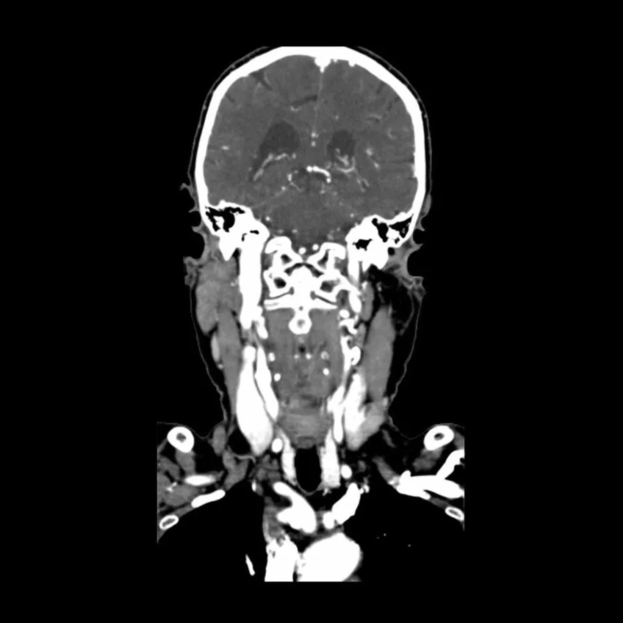 Head and Neck Phantom - CTA