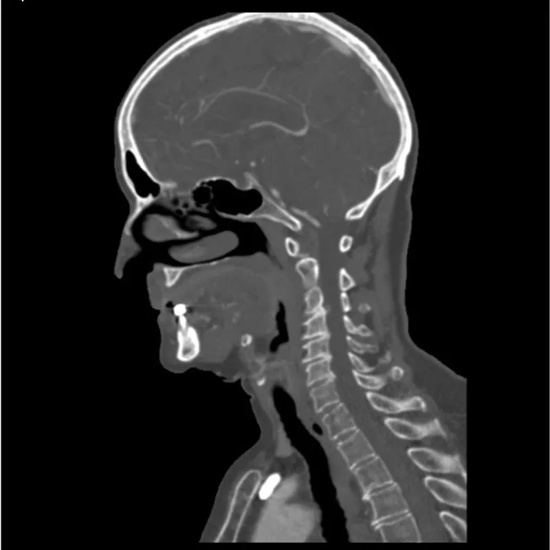 Head and Neck Phantom - CTA