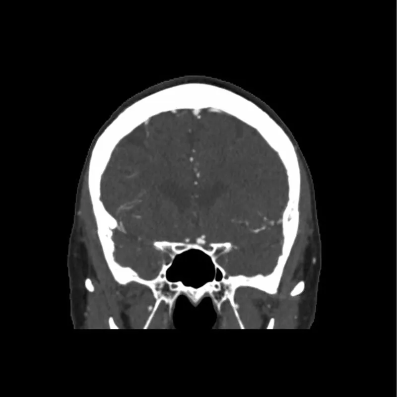 Head Phantom - CTA Aneurysm