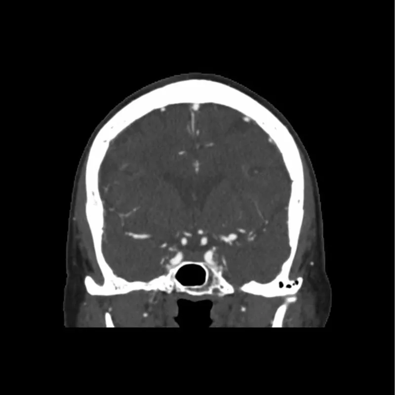 Head Phantom - CTA Aneurysm