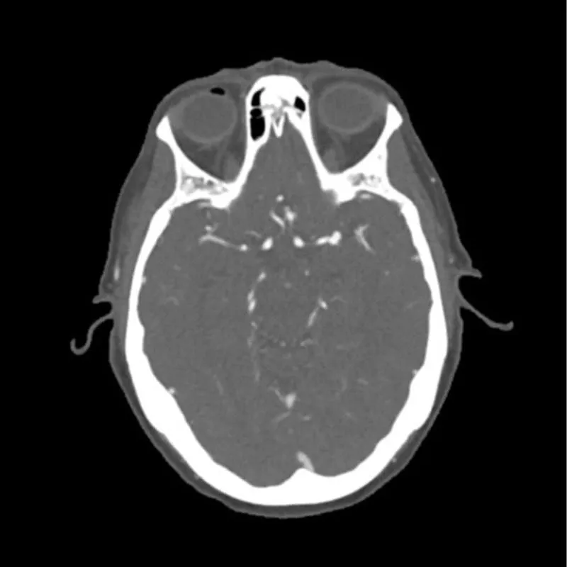 Head Phantom - CTA Aneurysm