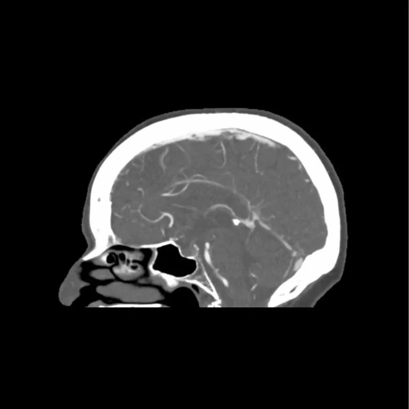 Head Phantom - CTA Aneurysm