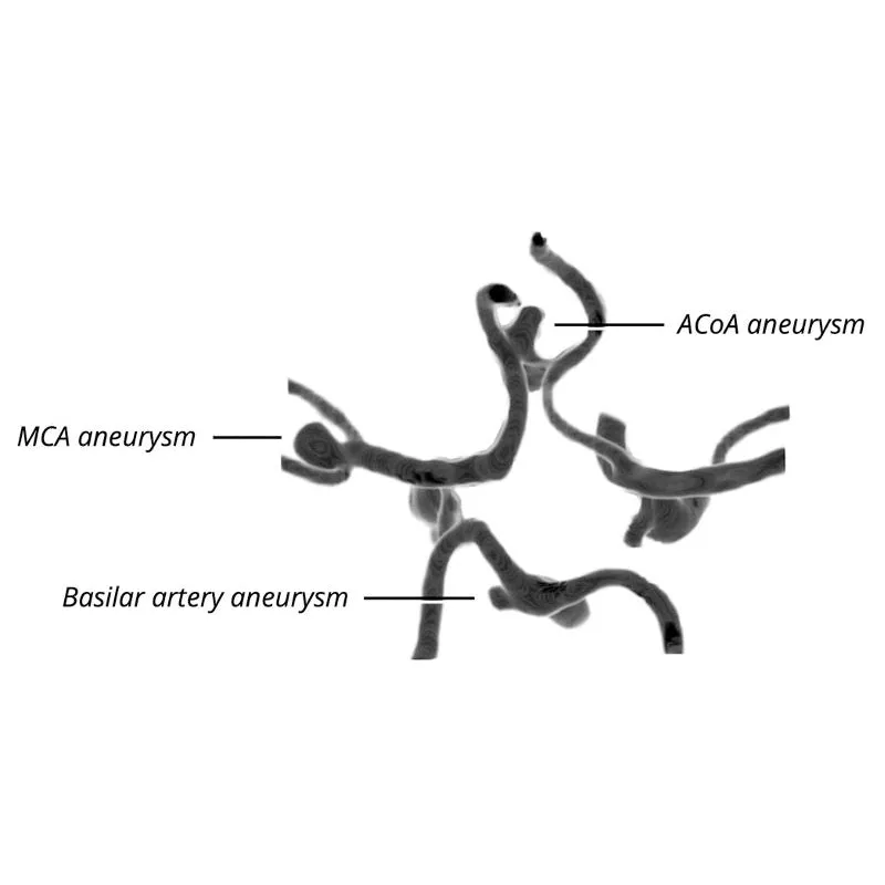 Head Phantom - CTA Aneurysm