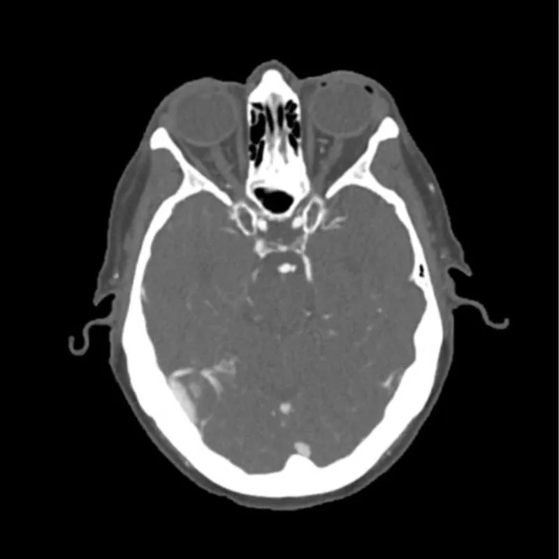 Head Phantom - CTA Aneurysm