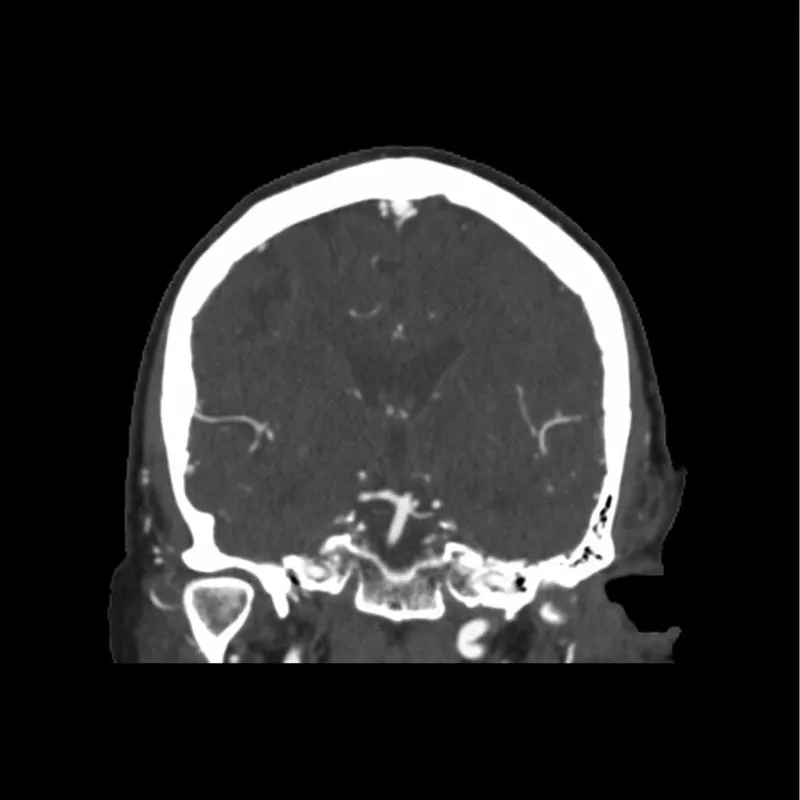 Head Phantom - CTA Aneurysm