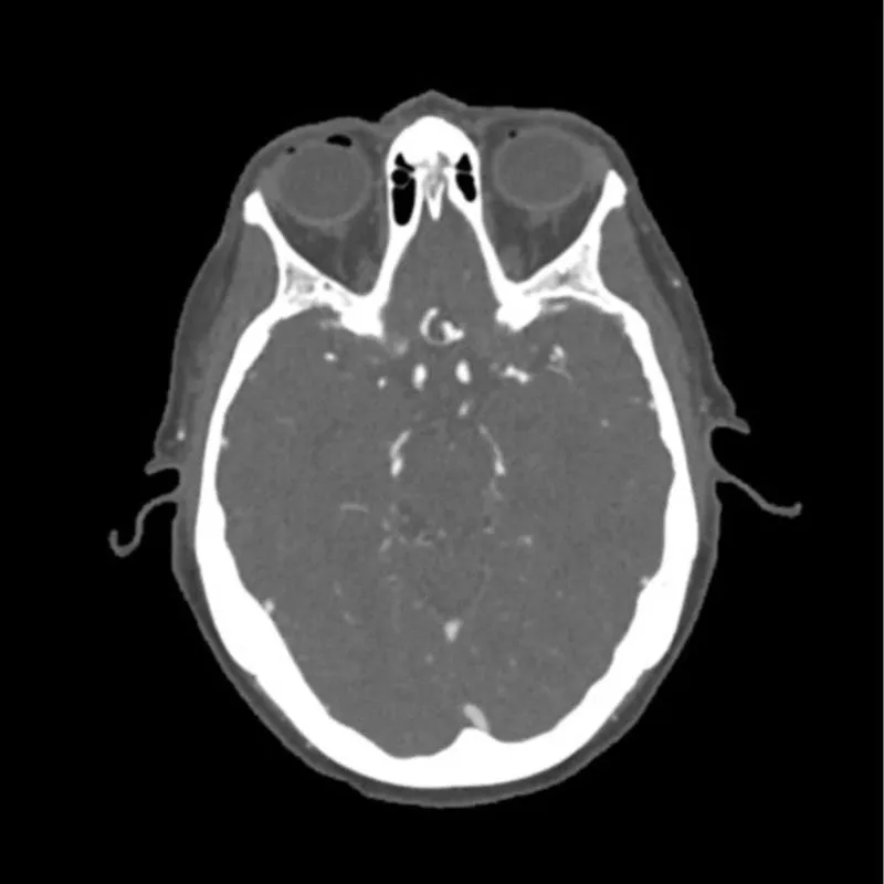 Head Phantom - CTA Aneurysm