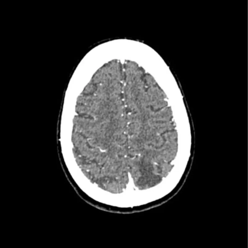 Head Phantom - CTA Aneurysm