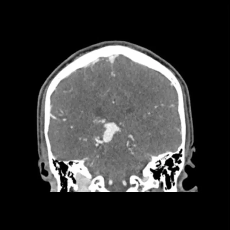 Head Phantom - CTA AVM / Lesion