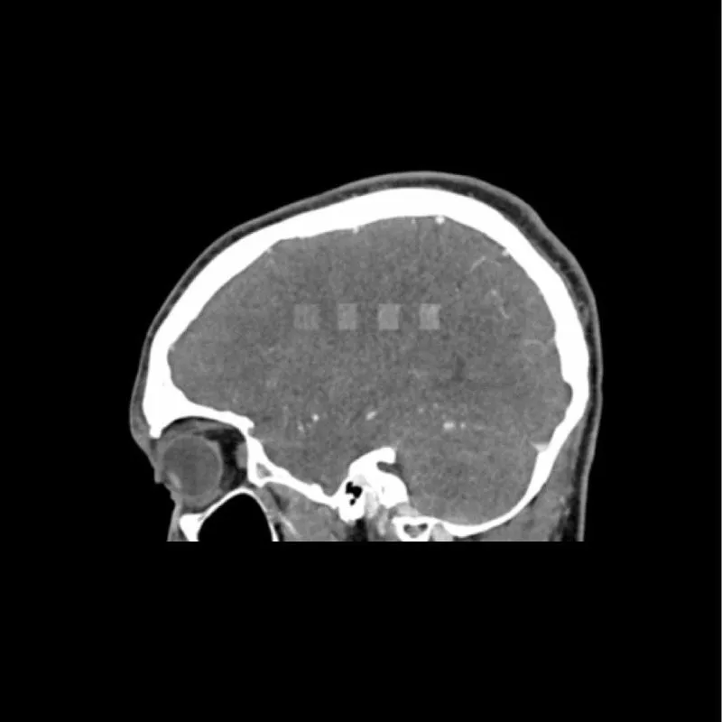 Head Phantom - CTA AVM / Lesion