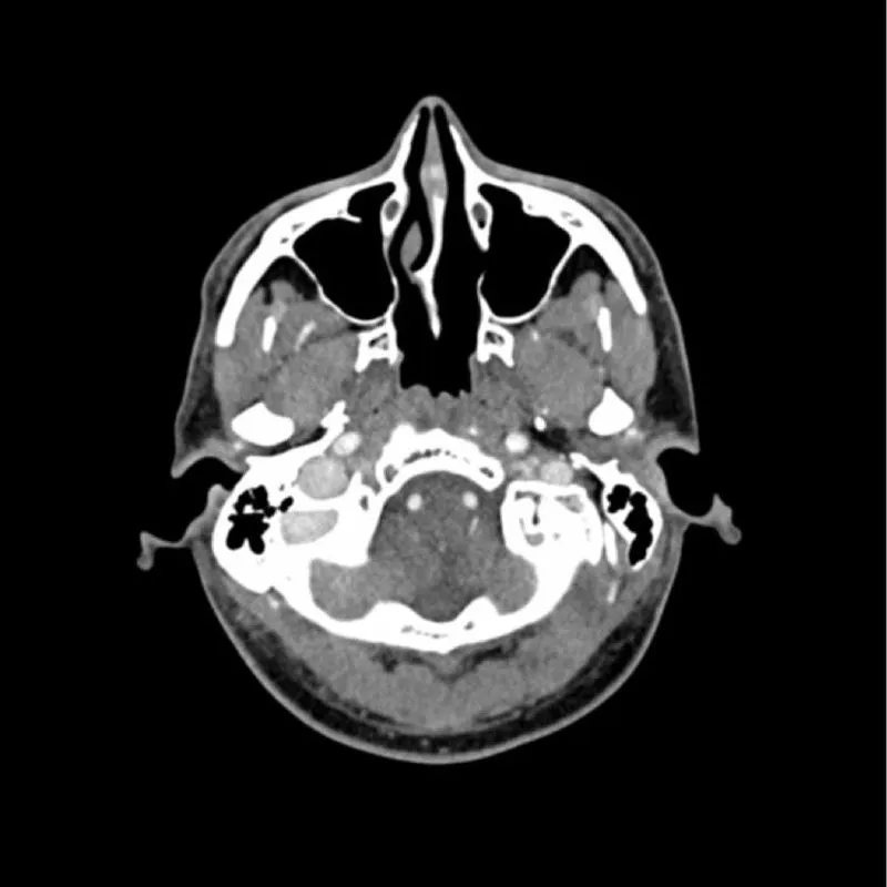 Head Phantom - CTA AVM / Lesion