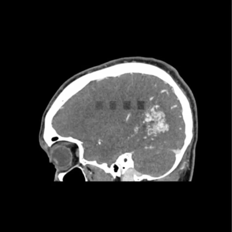 Head Phantom - CTA AVM / Lesion