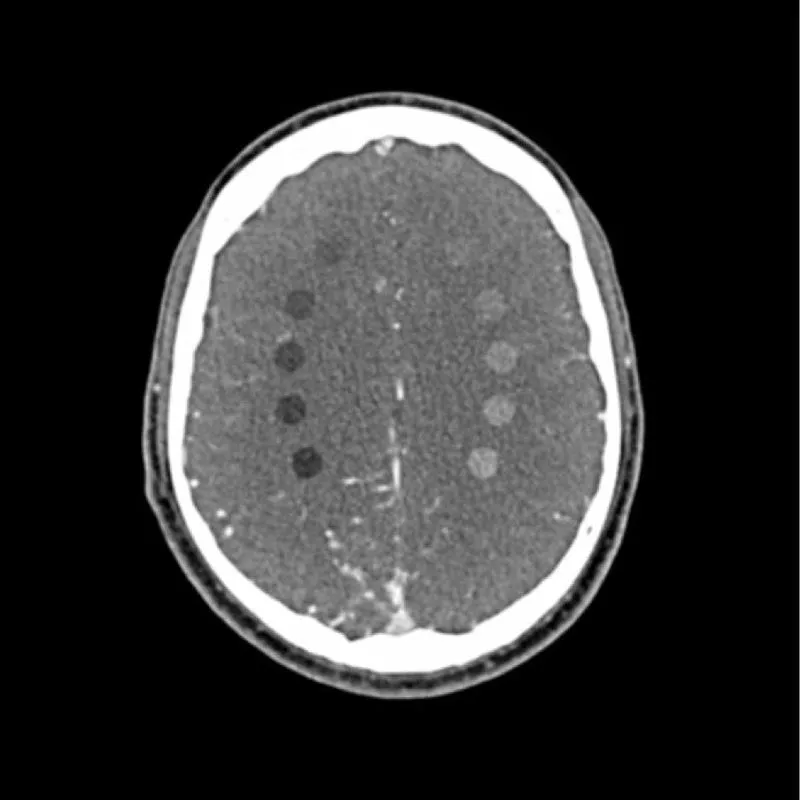 Head Phantom - CTA AVM / Lesion