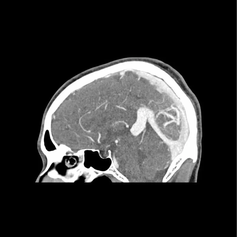 Head Phantom - CTA AVM / Lesion