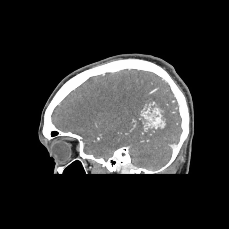 Head Phantom - CTA AVM / Lesion