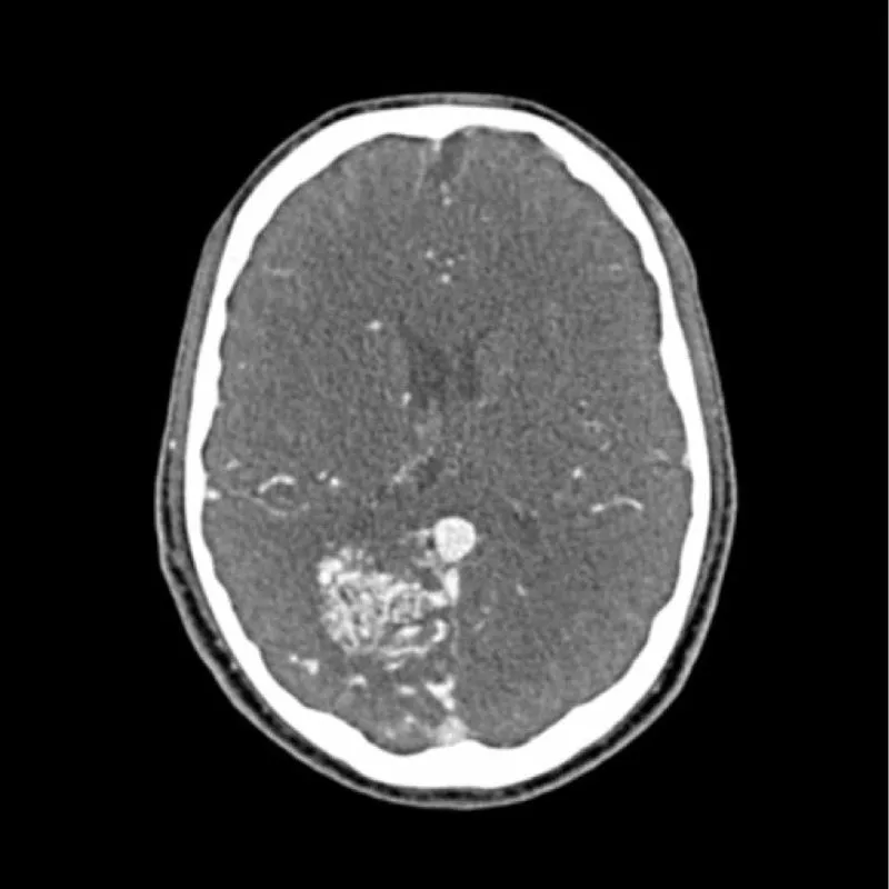 Head Phantom - CTA AVM / Lesion