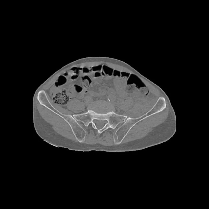 Pelvis Phantom - Femoral Neck Fracture