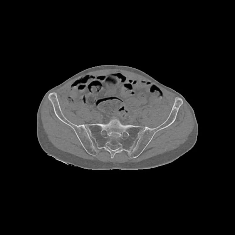 Pelvis Phantom - Femoral Neck Fracture