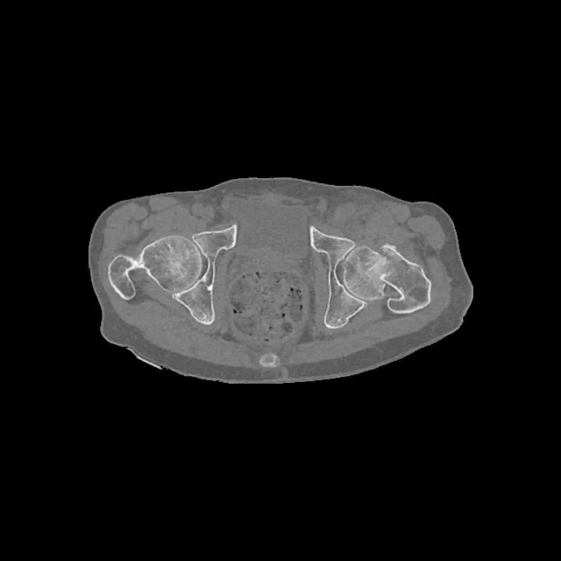 Pelvis Phantom - Femoral Neck Fracture