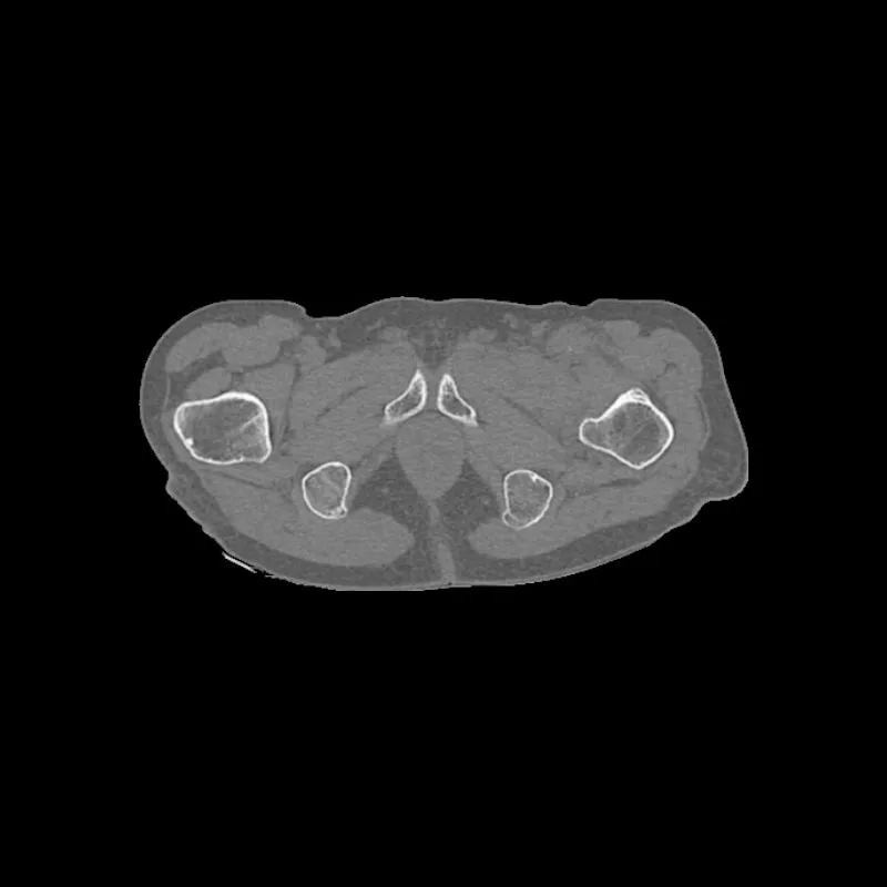 Pelvis Phantom - Femoral Neck Fracture