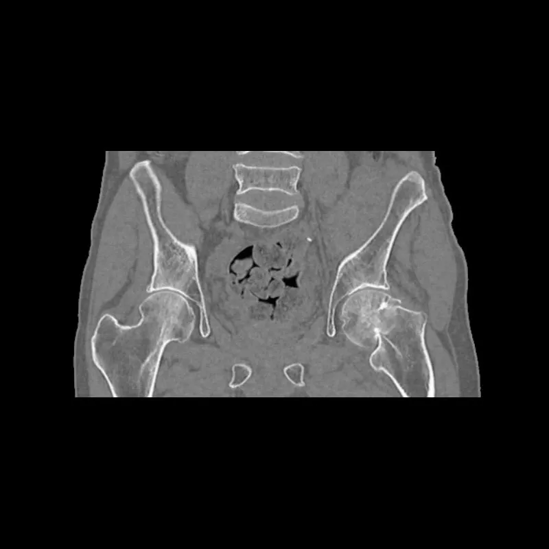 Pelvis Phantom - Femoral Neck Fracture