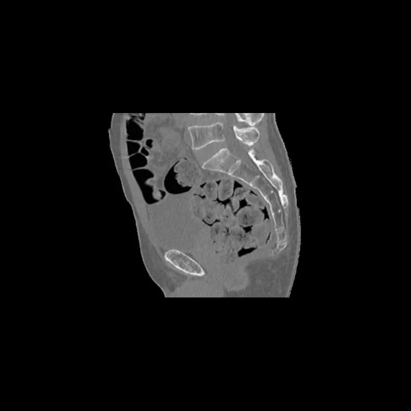 Pelvis Phantom - Femoral Neck Fracture