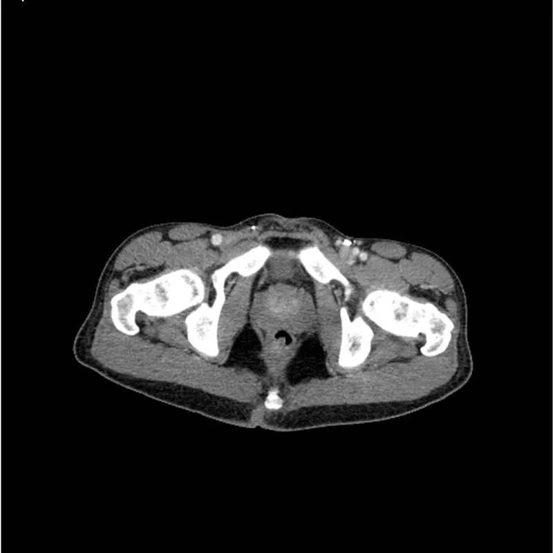 Torso Phantom - Portal Venous Phase