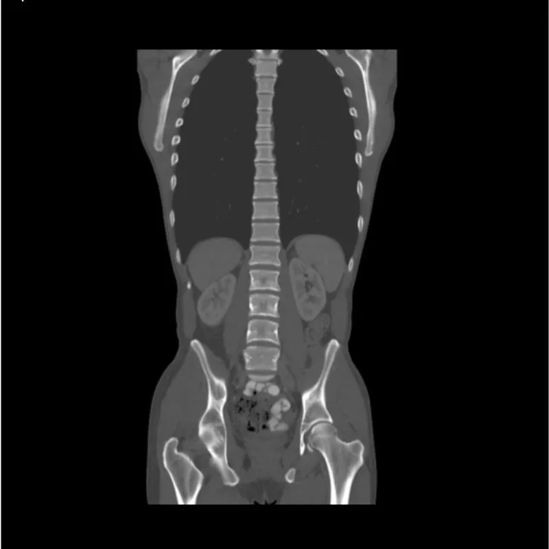 Torso Phantom - Portal Venous Phase