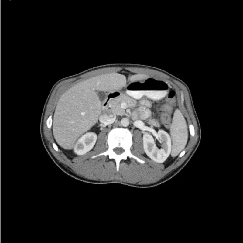 Torso Phantom - Portal Venous Phase