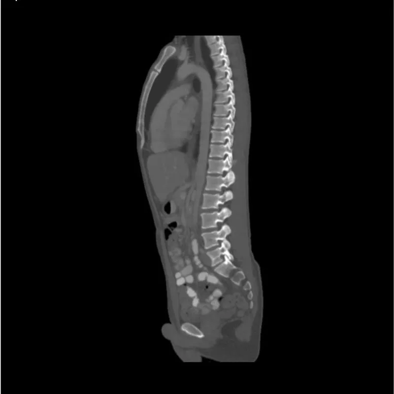 Torso Phantom - Portal Venous Phase