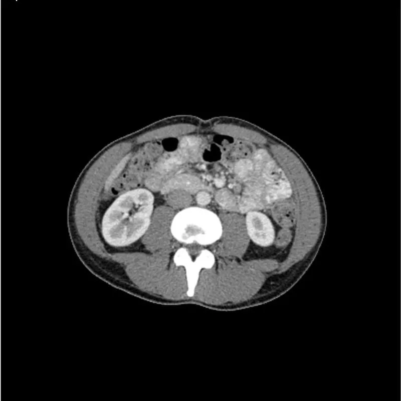 Torso Phantom - Portal Venous Phase