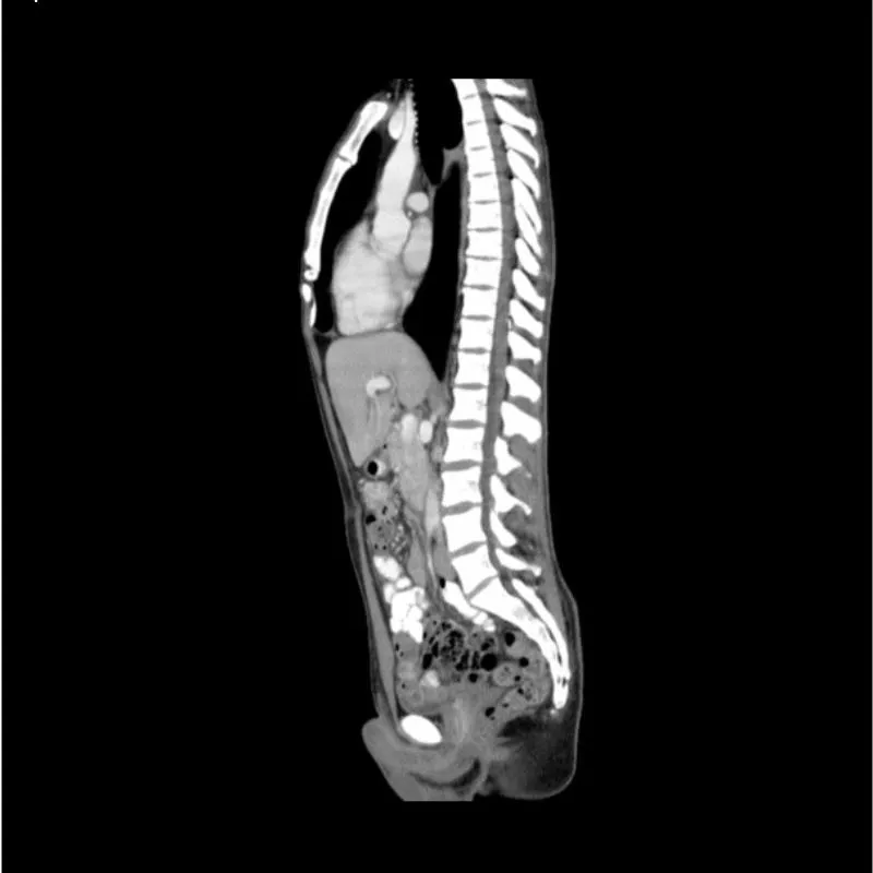 Torso Phantom - Portal Venous Phase